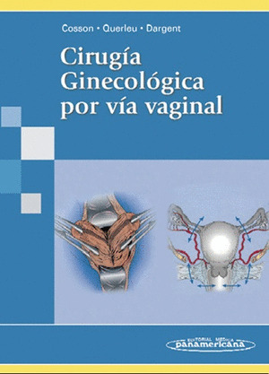 CIRUGÍA GINECOLÓGICA POR VÍA VAGINAL
