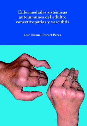 ENFERMEDADES SISTEMICAS AUTOINMUNES DEL ADULTO: CONECTIVOPATIAS Y VASCULITIS.