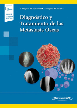 DIAGNOSTICO Y TRATAMIENTO DE LAS METASTASIS OSEAS (INCLUYE VERSION DIGITAL)