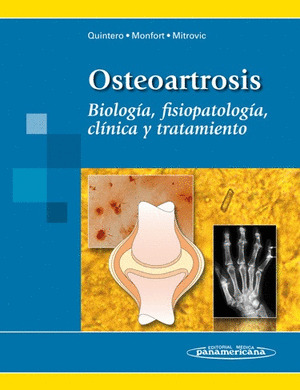 OSTEOARTROSIS; BIOLOGIA, FISIOPATOLOGIA, CLINICA Y TRATAMIENTO