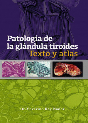 PATOLOGÍA DE LA GLÁNDULA TIROIDES