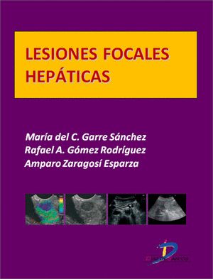 LESIONES FOCALES HEPÁTICAS