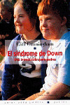 SINDROME DE DOWN